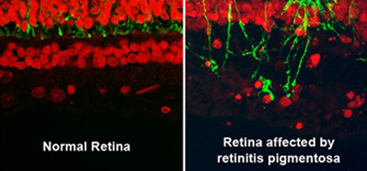 Retina scan comparison of rods and cones in normal vision and retina affected by retinitis pigmentosa