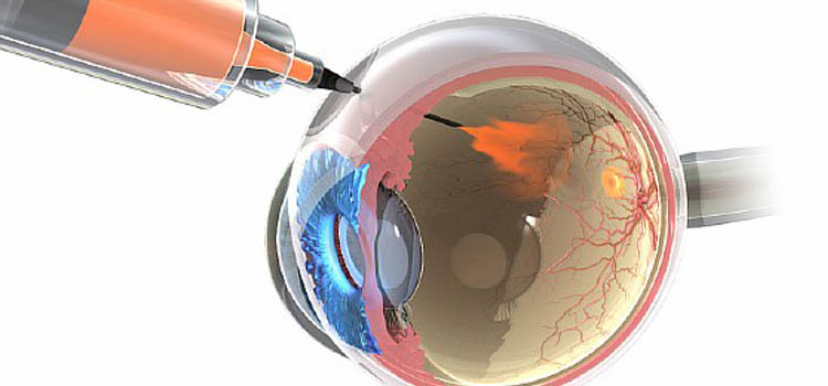 graphic showing a syringe injecting anti-VEGF into an eye